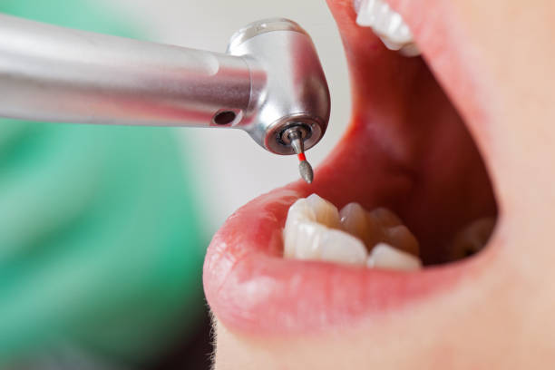 Best Emergency Broken Tooth Repair in Sharonville, OH